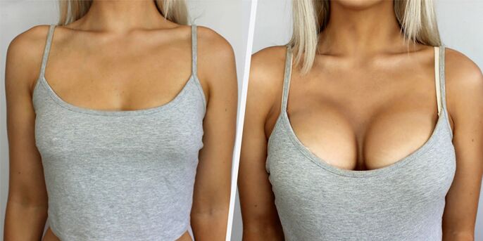 преди и след пластична операция за уголемяване на гърдите