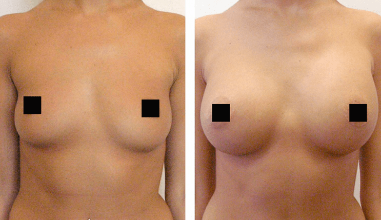 гърди преди и след уголемяване с хиалуронова киселина
