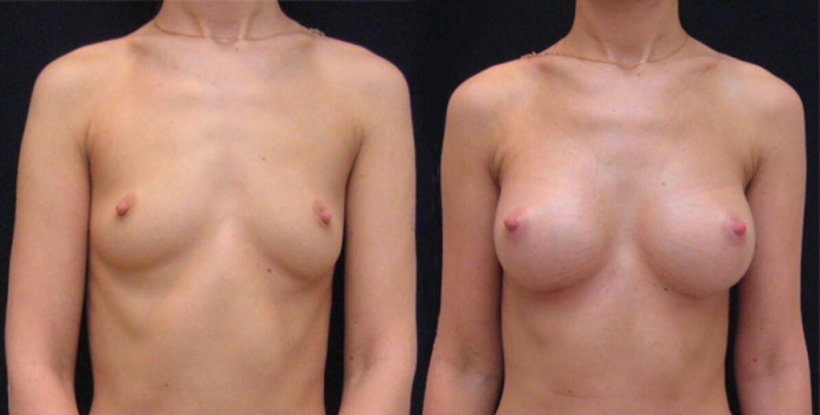 гърдата преди и след ендоскопско уголемяване