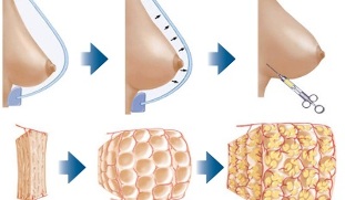 как се извършва процедурата за уголемяване на бюста с мазнини