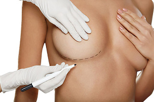 Маркиране с маркер преди операция за уголемяване на бюста